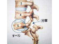 腰椎滑脱