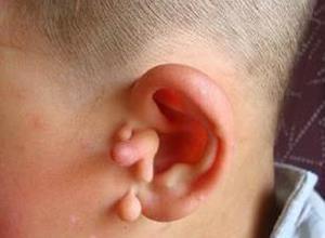 副耳