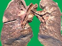 肺原发性结核性复征