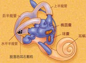 耳石症