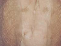 外阴鳞状上皮细胞增生