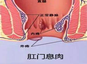 肛门息肉