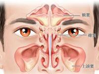 筛窦炎