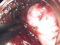食管间质瘤