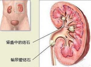 肾结核对侧肾积水