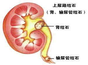 肾及输尿管结石