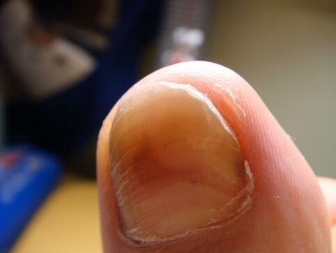 灰指甲不治或导致恶性肿瘤