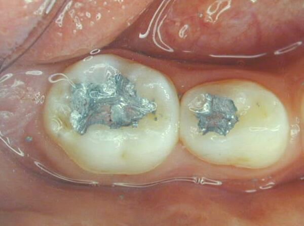 窝沟充填可阻断六龄牙发展成龋齿