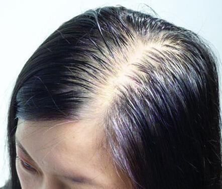 30种疾病可能导致女性脱发