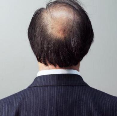 如何预防青年期脱发及早秃