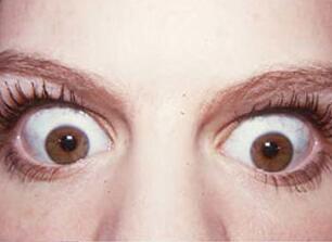 什么是甲亢性突眼？