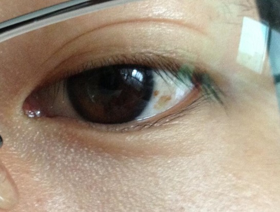 维生素可阻止眼底黄斑变性失明