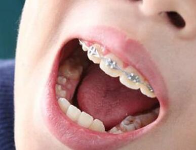常见牙周炎有那些？