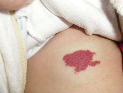 激光治疗红胎记理想又安全