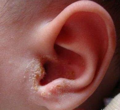 喂奶姿势不对可能会导致宝宝中耳炎