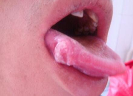 常咬到舌头小心患舌癌