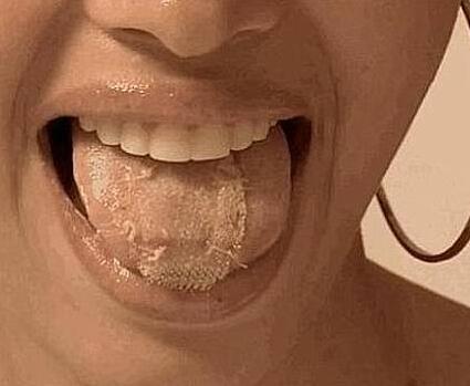 常咬到舌头小心患舌癌