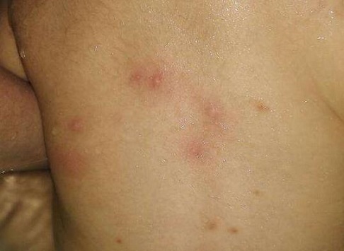 春季如何预防突发皮疹?