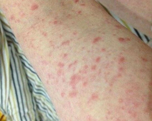 什么是小儿急疹？小儿急疹的症状有哪些？