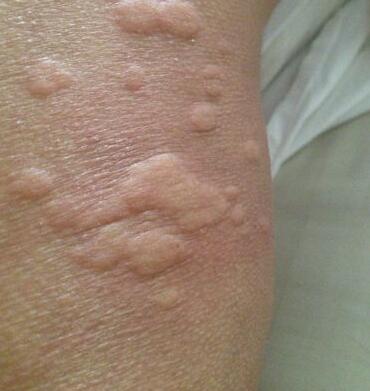 二期梅毒的皮疹表现是什么