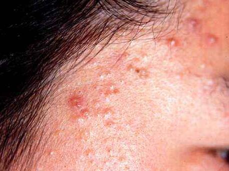 尖锐湿疣初期常见淡红色丘疹