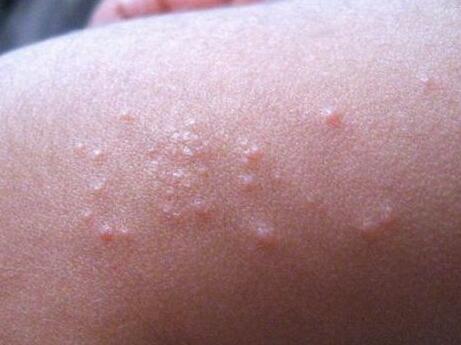 小儿丘疹性荨麻疹的症状表现