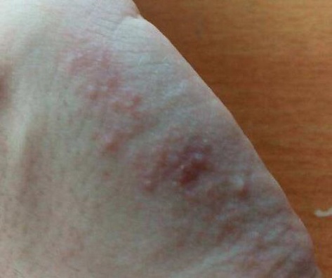 尖锐湿疣初期常见淡红色丘疹