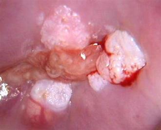 什么引起尖锐湿疣发病或复发?