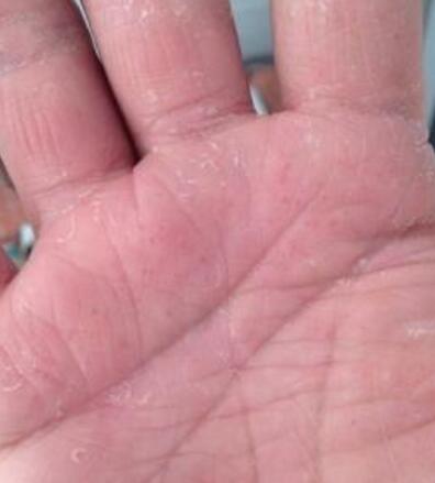 冬季如何全方位防治手部湿疹？