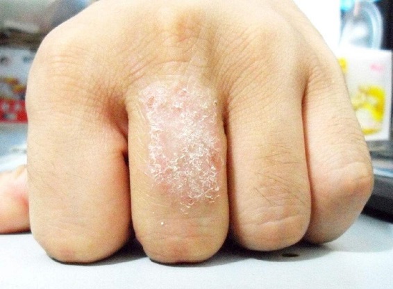 手部湿疹会传染给别人吗？