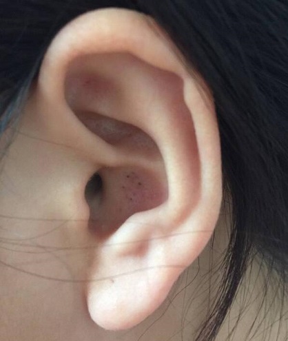耳朵的保健新方心肾相交法