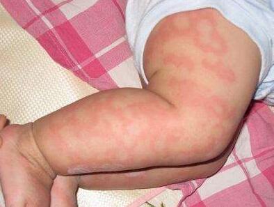 饮食疗法防治小儿湿疹