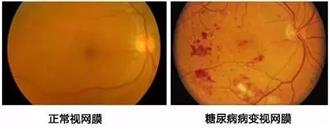 高血糖患者注意！江门爱尔新希望送福利！