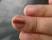 灰指甲怎么治疗？灰指甲特效药与治疗方法