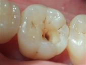 预防龋齿小儿3岁起需使用牙线