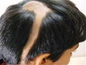 假发对治疗斑秃影响