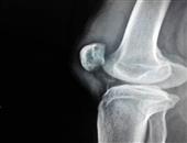女性膝盖疼痛当心髌骨软化症