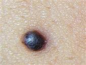 權威專家公布十大疾病信號黑痣變大警惕皮膚癌