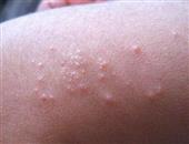 丘疹性荨麻疹扰人8%与环境有关