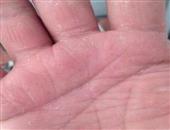 如何预防手部湿疹？