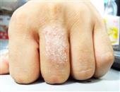 手部湿疹会传染给别人吗？