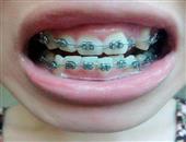 预防牙周病银发族牙齿矫正掀风潮