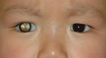 眼癌是什么病 眼癌的早期症状