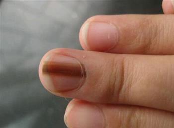 夏天到来如何预防灰指甲？