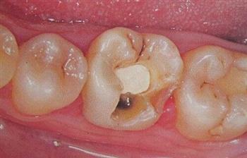 预防龋齿小儿3岁起需使用牙线