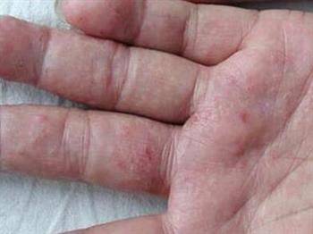 手癣与汗疱疹的区别