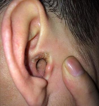 慢性化脓性中耳炎的三型