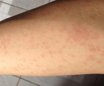 荨麻疹是夏季好发皮肤病