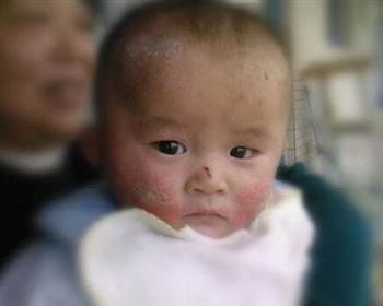 婴儿湿疹症状及治疗 婴儿湿疹小介绍