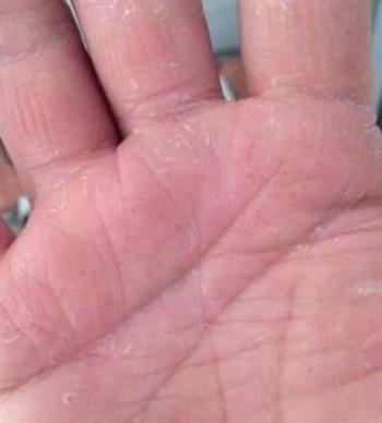 家庭主妇如何做好手部湿疹的预防